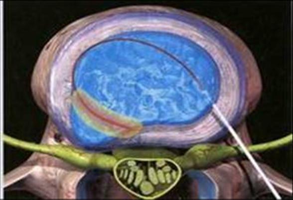 腰腿痛的诊断与非手术治疗,腰腿痛的康复治疗
