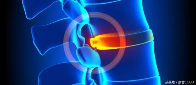 腰椎间盘突出脚发麻治疗医院广州,昆明腰椎间盘突出康复治疗中心