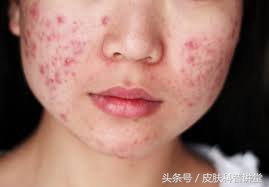 果酸焕肤精华液与果酸的区别,什么样的人需要果酸换肤