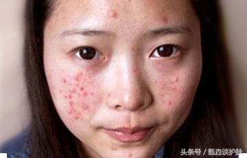 如何去除痘印痘疤痘坑,如何去除痘印留下的痣