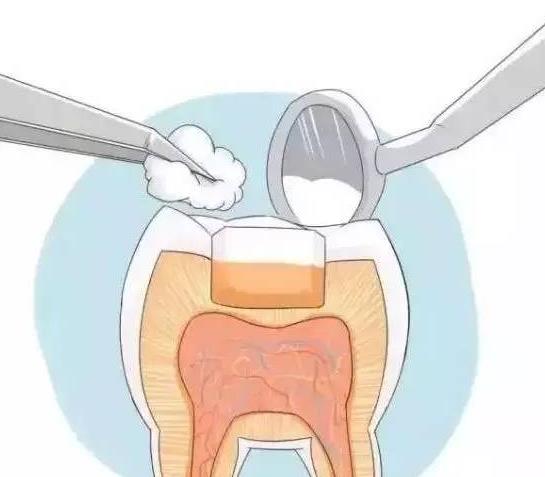 临时补的牙齿能用多久,牙齿上药后能延迟多久去补