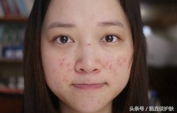 如何去除痘印,如何去除痘印留下的痣