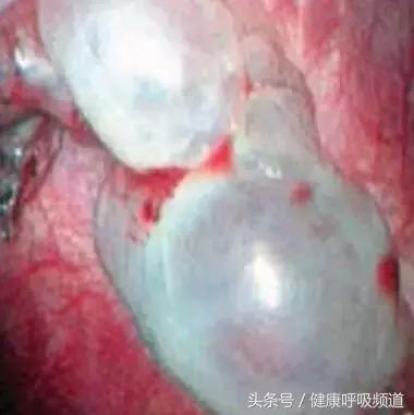 慢阻肺肺气肿的最佳治疗方法,肺气肿买什么样的呼吸锻炼仪好