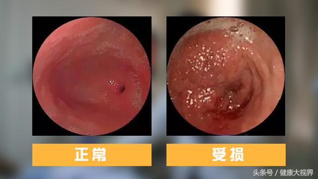 服用奥美拉唑2年消化不良怎么办,吃了2年的奥美拉唑危害