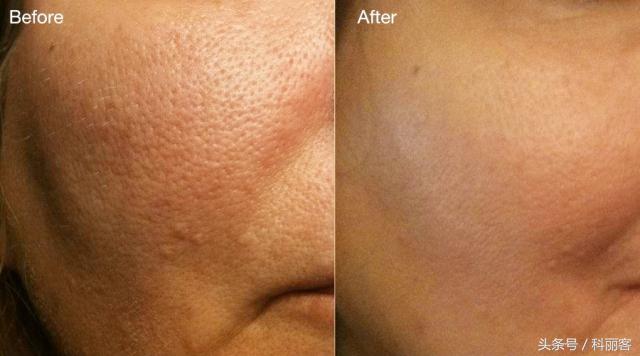 改善毛孔粗大最简单有效的方法,如何有效改善毛孔粗大的方法