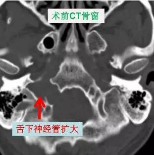 舌头突然不利索,舌头突然间不好使一会就好了