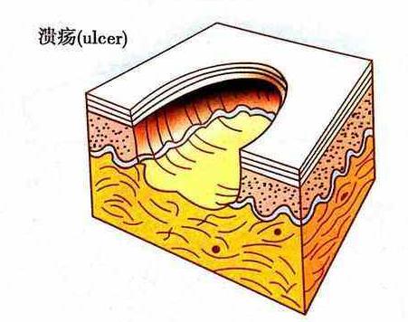 口腔溃疡寻医问药,求医口腔溃疡