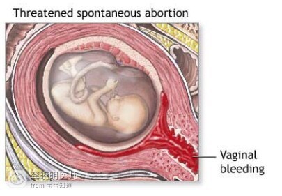 医学科普妊娠晚期,早孕出血生化怎么办