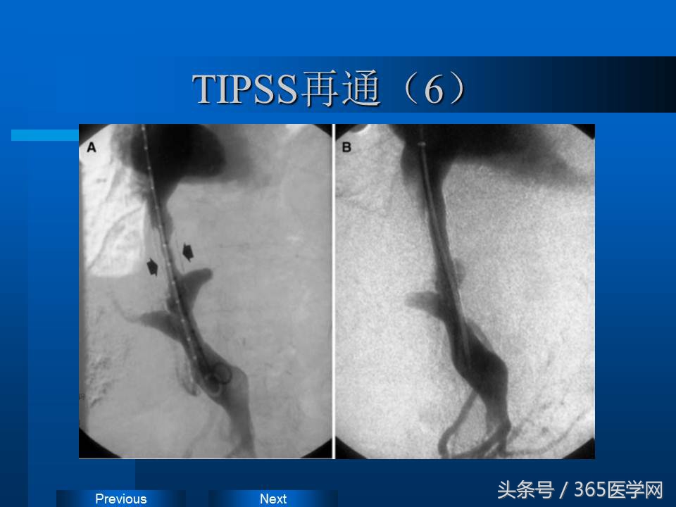 崔进国：消化道出血的介入治疗