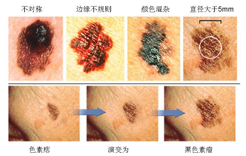 长在手指头的黑点是癌细胞吗,手指黑点癌症特征