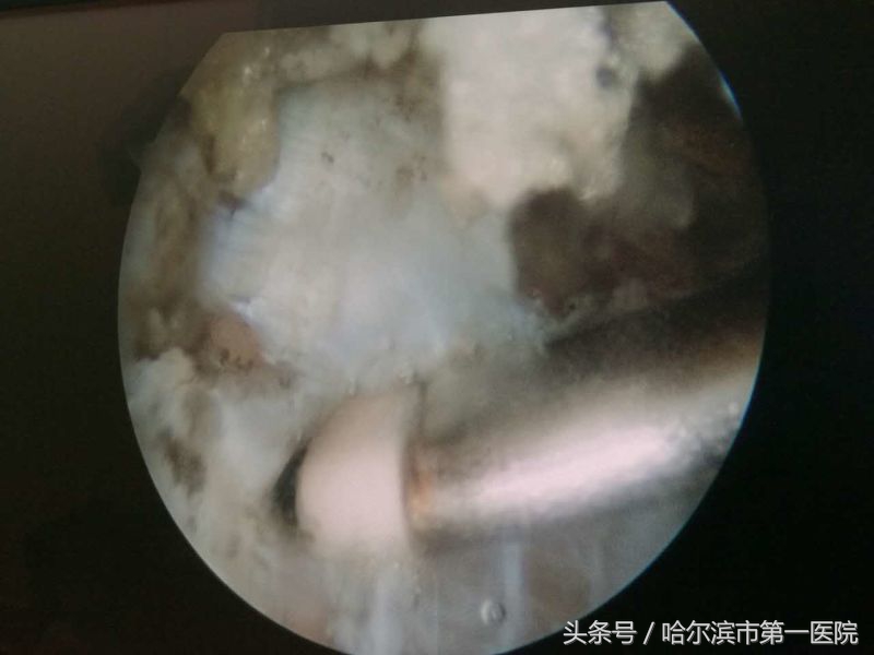 走路胯疼最快缓解方法,走路胯骨响怎么纠正