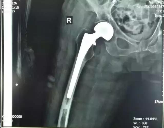 人生最后一次骨折保守治疗,髋部骨折又称人生最后一次骨折