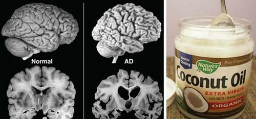 椰子油治帕金森,椰子油可以治疗帕金森综合征