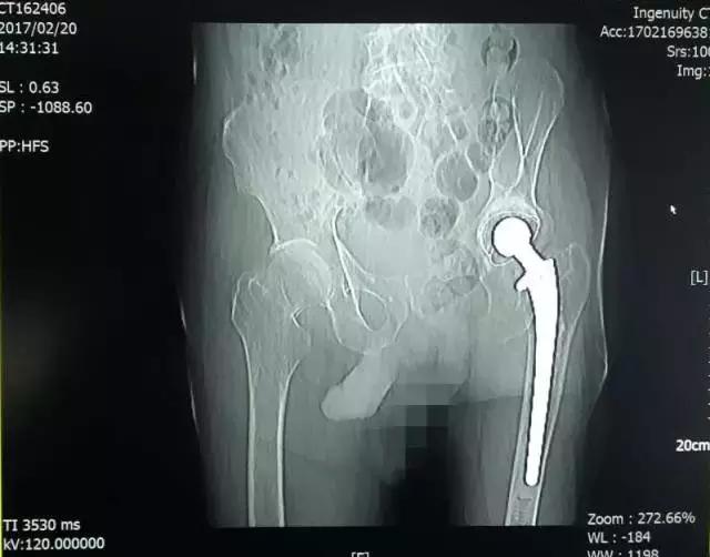 人生最后一次骨折保守治疗,髋部骨折又称人生最后一次骨折