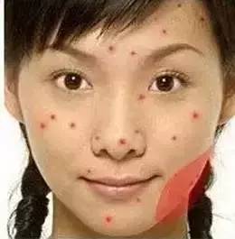 为什么长闭口粉刺痘痘还总是反复,痘痘反复长你知道是为什么吗