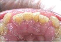 牙龈不增生的降压药,降压药引起的牙龈增生会好吗