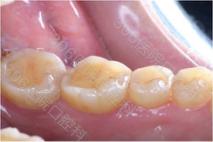 牙龈不增生的降压药,降压药引起的牙龈增生会好吗