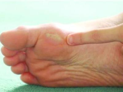 糖尿病足溃烂怎么治疗好得快,糖尿病足溃烂了一般怎么治疗