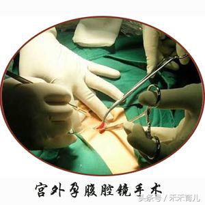 宫外孕早期症状有哪些表现,宫外孕基本知识