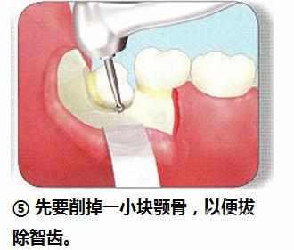 智齿横着长没露出来,智齿牙横着长怎么办