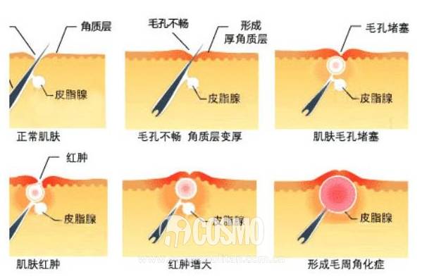 美人计｜在这个夏天和鸡皮肤说再见，你要这么做