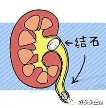 肾积水引发的尿漏怎么办,肾积水排尿困难吃什么药