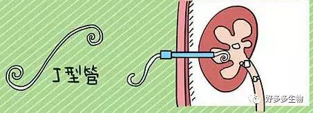 肾积水引发的尿漏怎么办,肾积水排尿困难吃什么药