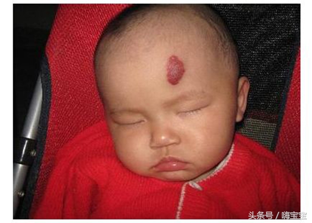 小孩皮肤胎记多,孩子身上各种颜色胎记