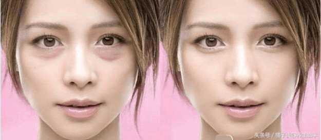 眼袋不仅丑还显老，中医教你从根本上去除眼袋