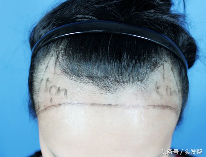 发际线高显老怎么办,发际线高方圆脸怎么办