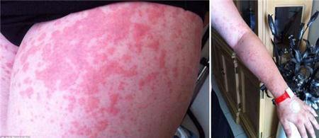 孕妇出现很多纹,孕妇肚子上长妊娠纹有拉扯感