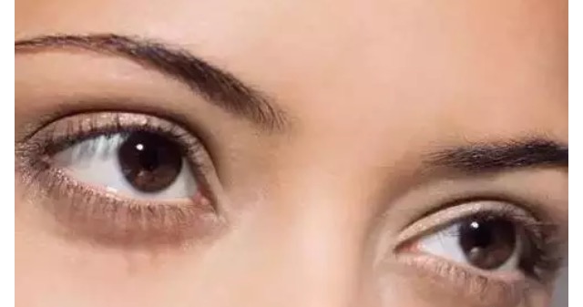 做双眼皮一个星期后感觉太宽了,第一次做双眼皮太窄了