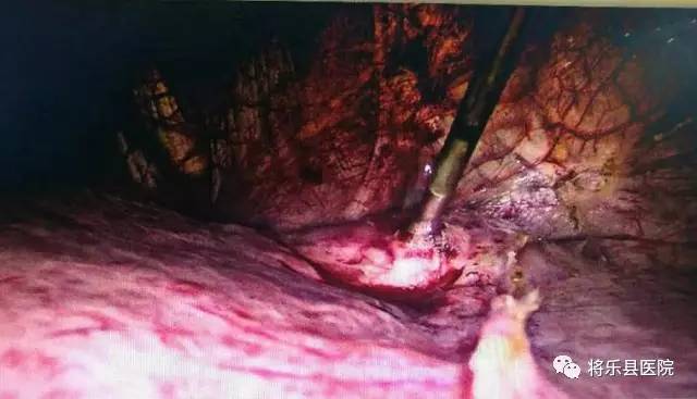 将乐一位原发性肝癌早期患者，在县总医院做完一件特殊的手术后，第二天便自己下床啦！