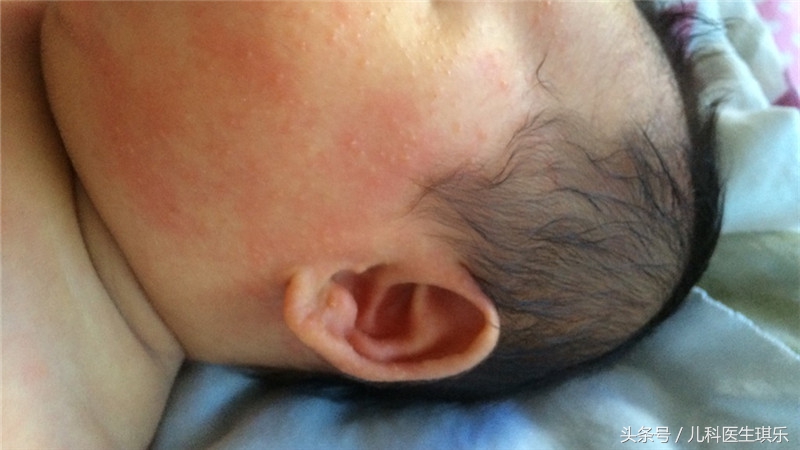 康复新液可以治疗湿疹吗,湿疹感染溃烂可以用康复新液吗