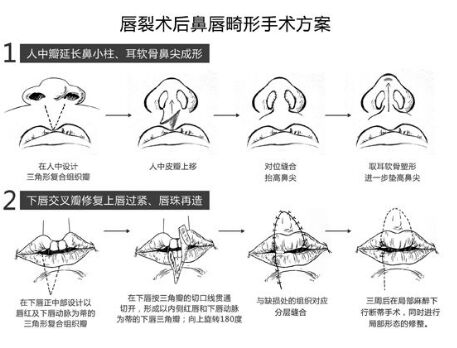 浙江有兔唇修复吗,成年人兔唇疤痕修复