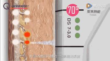 做超声科检查脖子要注意什么,超声刀做完起疙瘩能消失吗