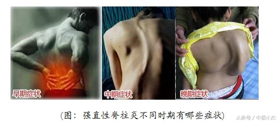 高考体检有强直性脊柱炎,孩子高考腰疼如何治疗