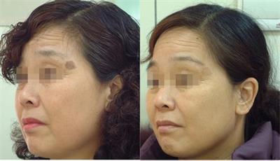 激光祛老年斑视频全过程,激光治老年斑的消除方法