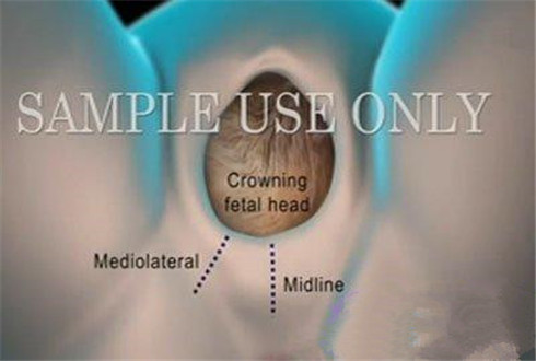 动画演示宝宝分娩侧切过程,产妇分娩侧切