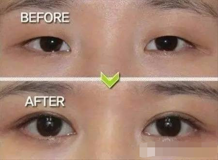 抢救假性眼纹、眼袋的黄金时间，错过你就老了