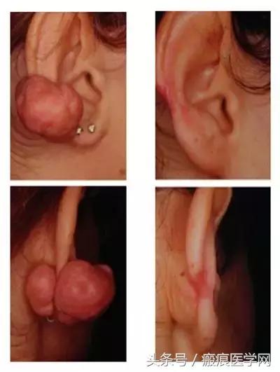 浅层放射治疗疤痕疙瘩,浅层x射线治疗疤痕疙瘩费用