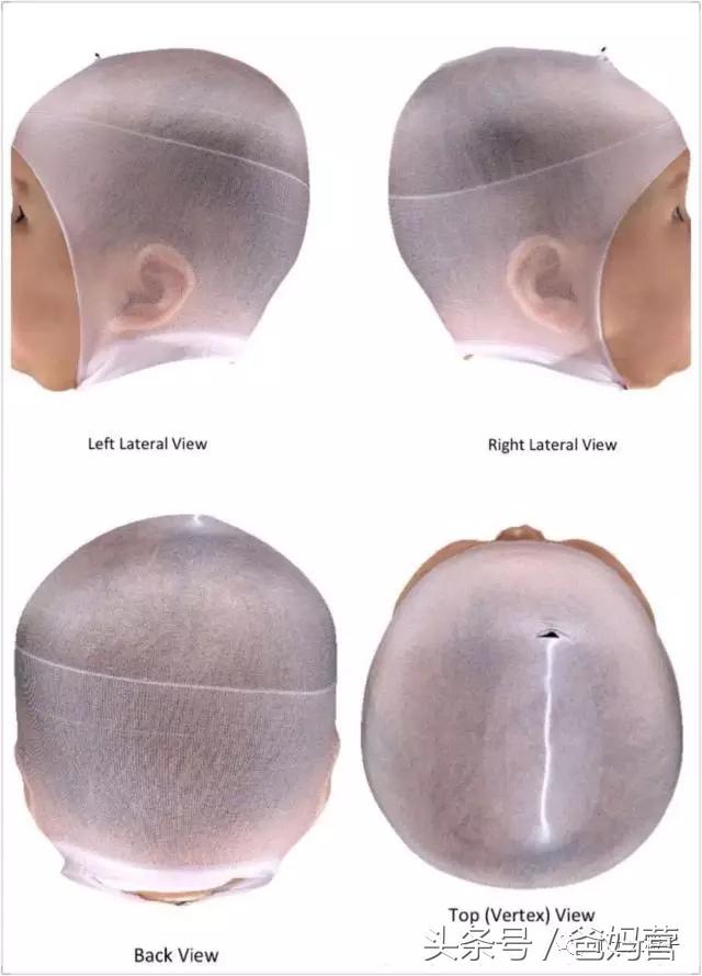 美国的宝宝扁头为什么要矫正,扁头在国外要做矫正吗