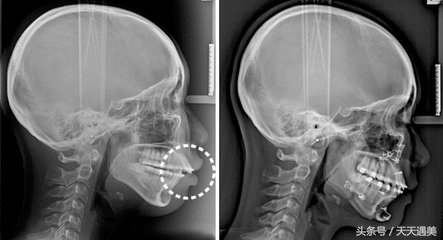 凸嘴到底有多可怕,突嘴是牙齿原因吗