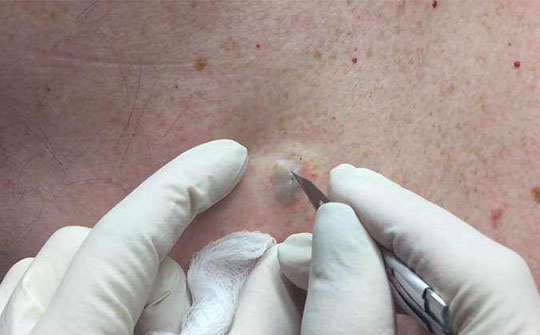 后背长痘怎么治疗最好的方法,青少年脸上和后背长痘怎么解决