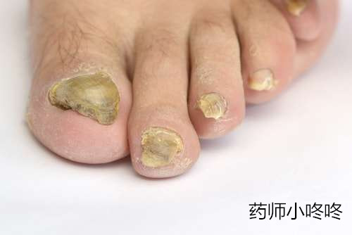 皮肤真菌感染要注意什么,皮肤真菌感染应该注意什么