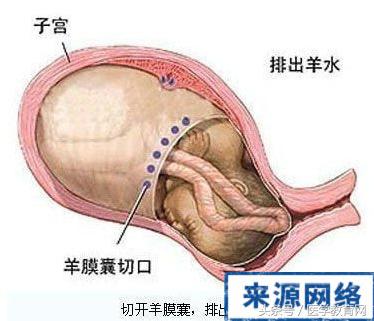 剖腹产女性手术,女的剖腹产手术的全部流程