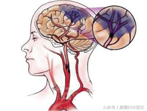 叶酸和维生素b6可以预防中风吗,叶酸能防中风吗