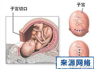 剖腹产女性手术,女的剖腹产手术的全部流程