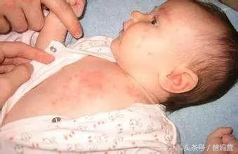 金银花泡澡治痱子,爽身粉痱子