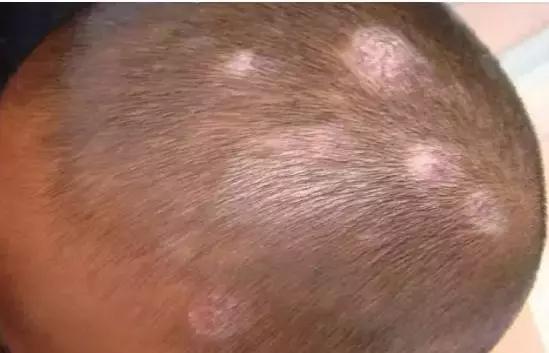 湿疹皮肤用药大全手册,湿疹性皮炎宣教